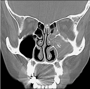 sinus rinse assist