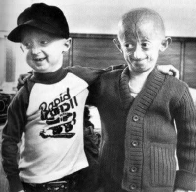 progeria2.jpg